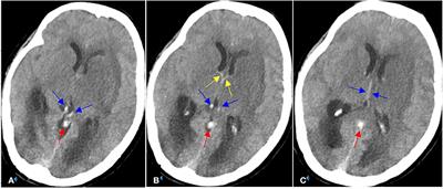 Use of Stent Retriever Thrombectomy Combined With Local Urokinase Thrombolysis for Deep Cerebral Vein Thrombosis: A Case Report